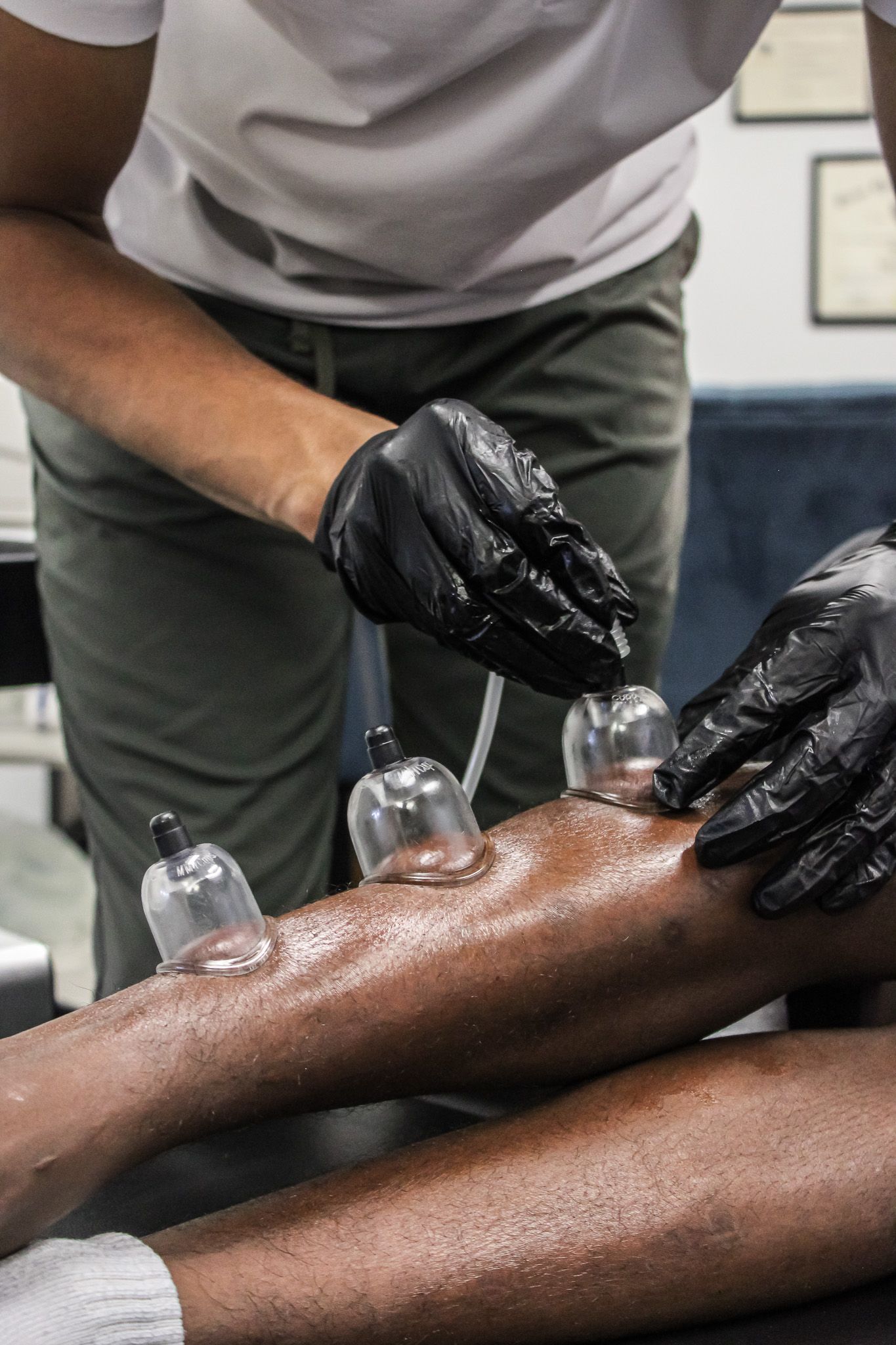 A man is laying on a table with cupping cups on his back.