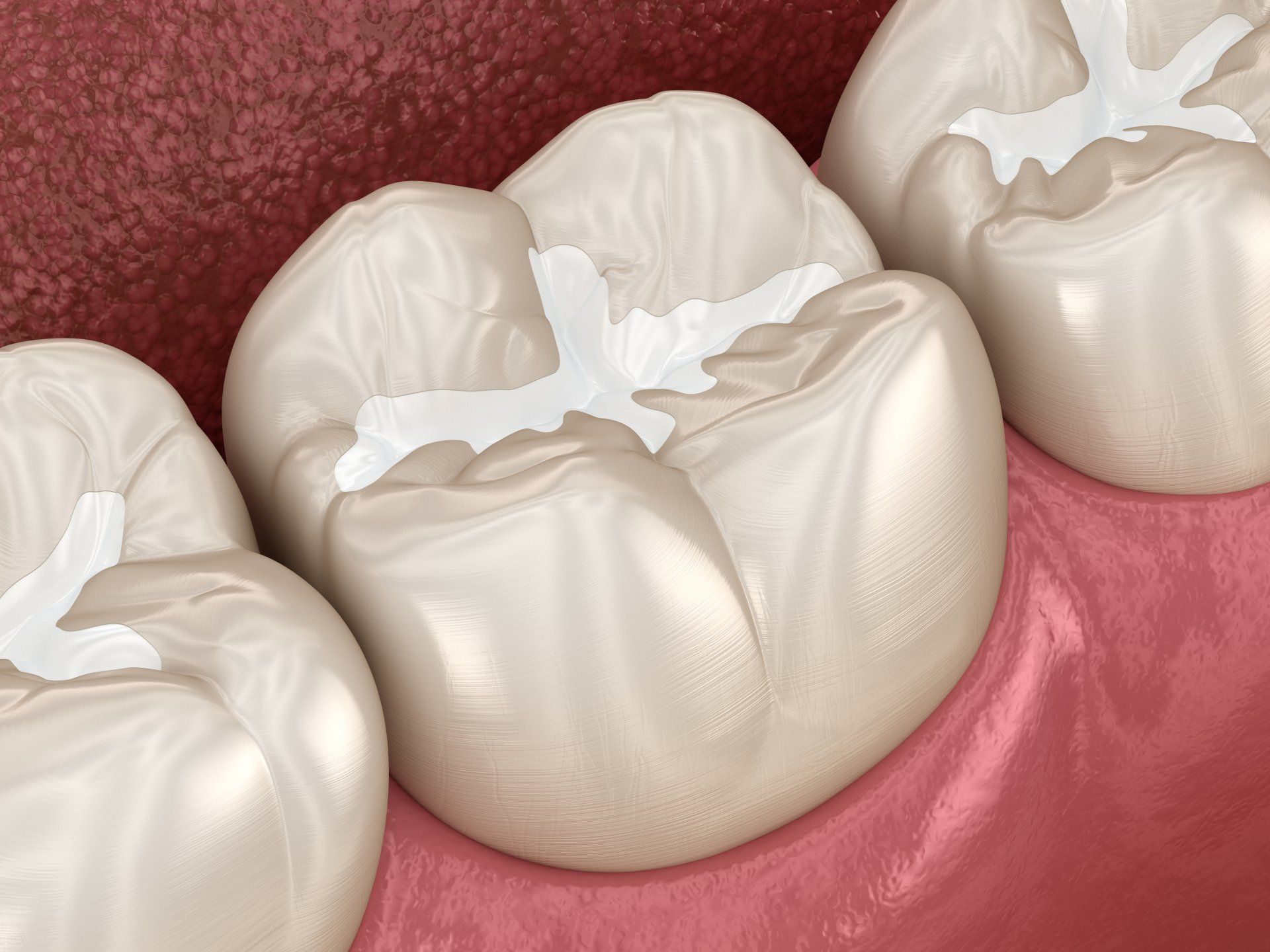 Composite dental fillings graphic