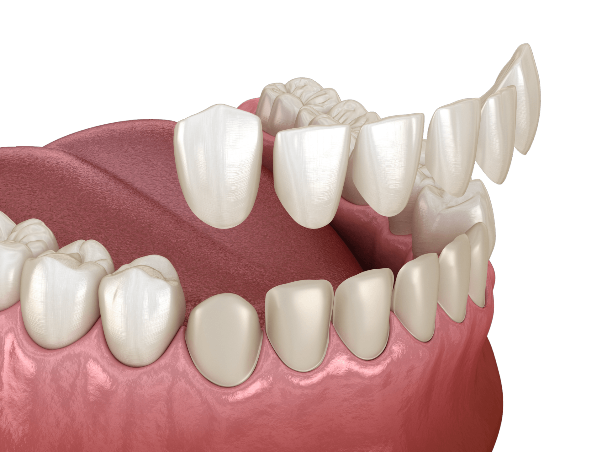Graphic image of teeth with porcelain veneers