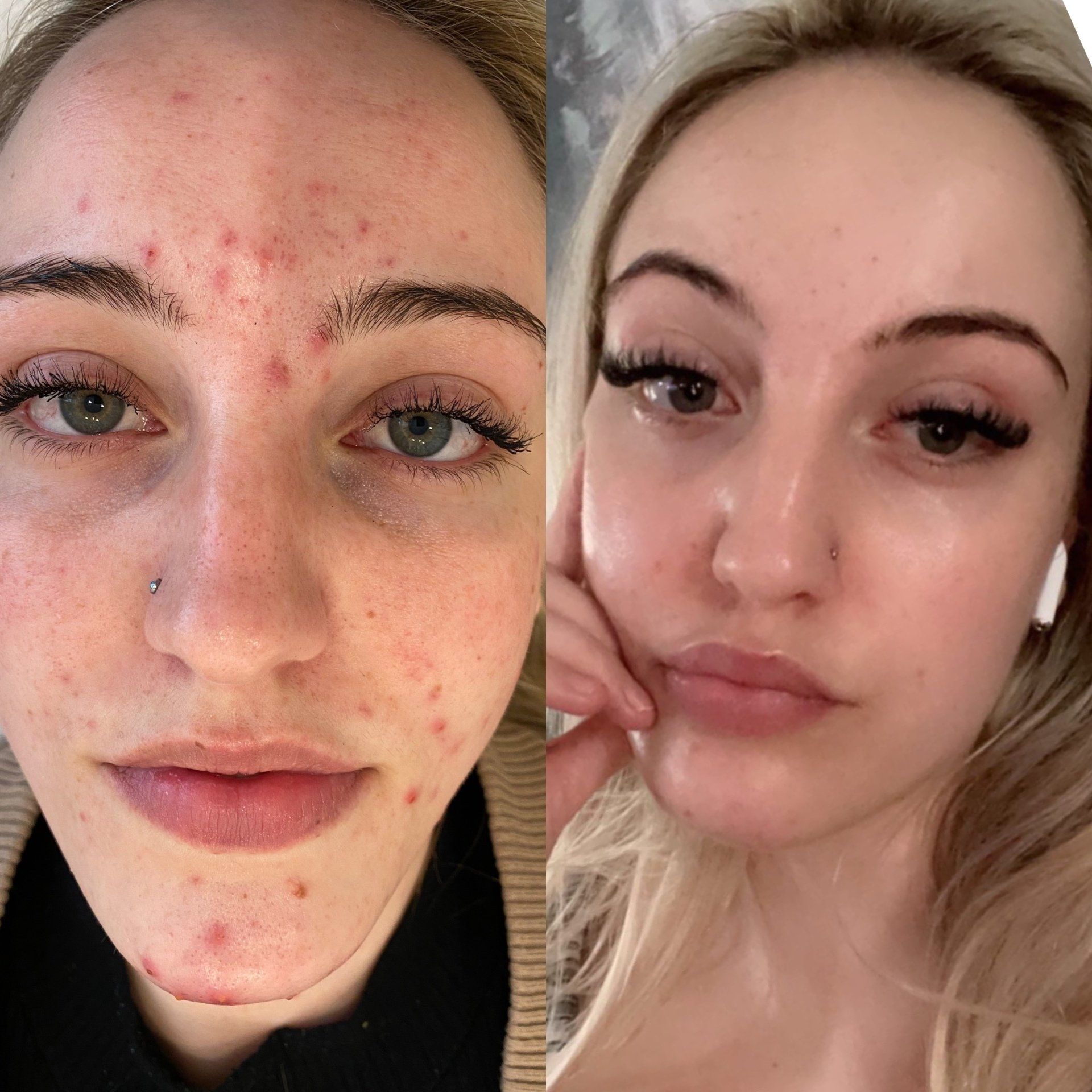 skin treatments before and after