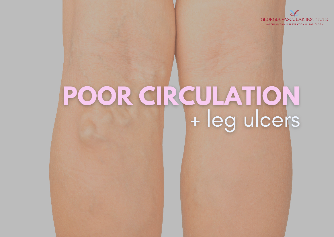 Poor Circulation and Leg Ulcers Graphic