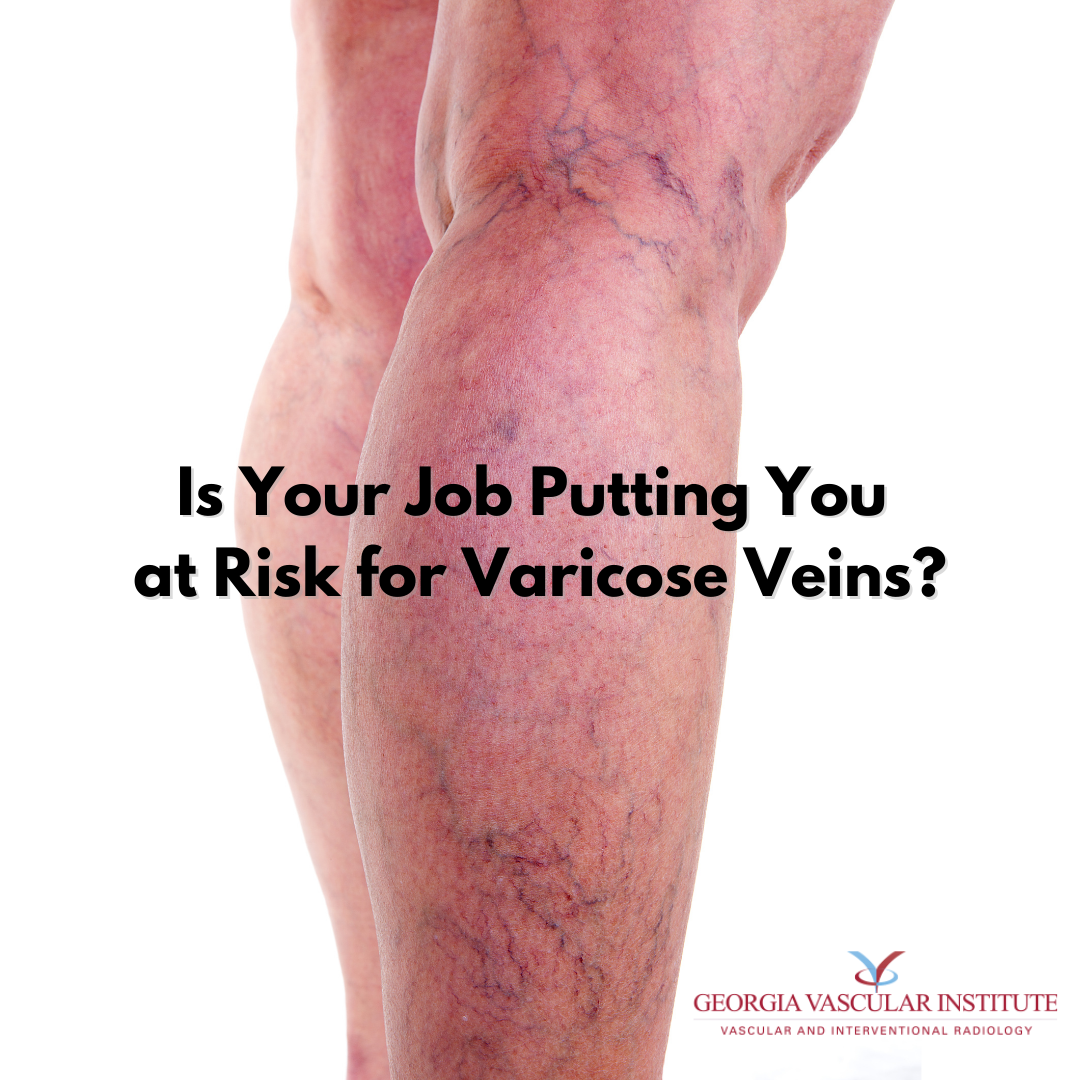 Is Your Job Putting You at Risk for Varicose Veins?
