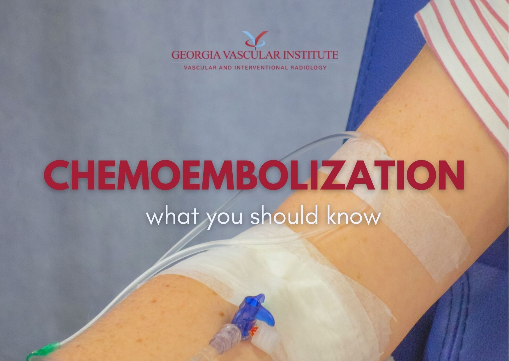 Chemoembolization Georgia