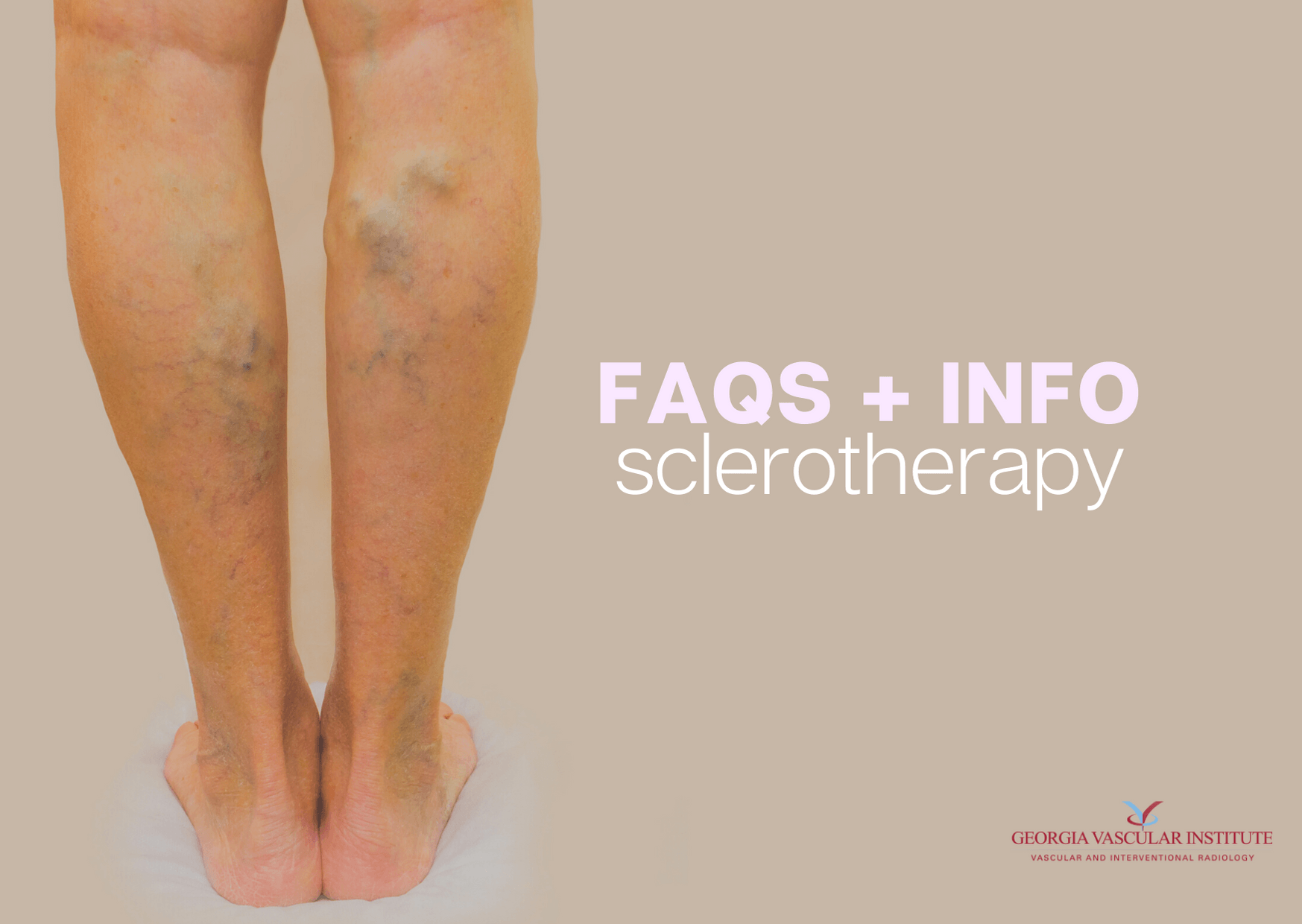 Sclerotherapy for Varicose Veins at Georgia Vascular Institute