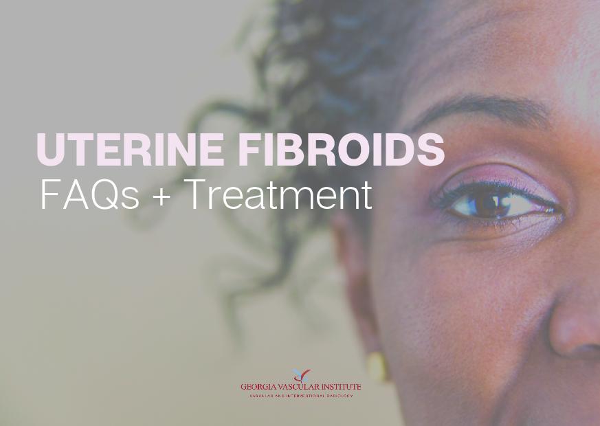 uterine fibroids faqs