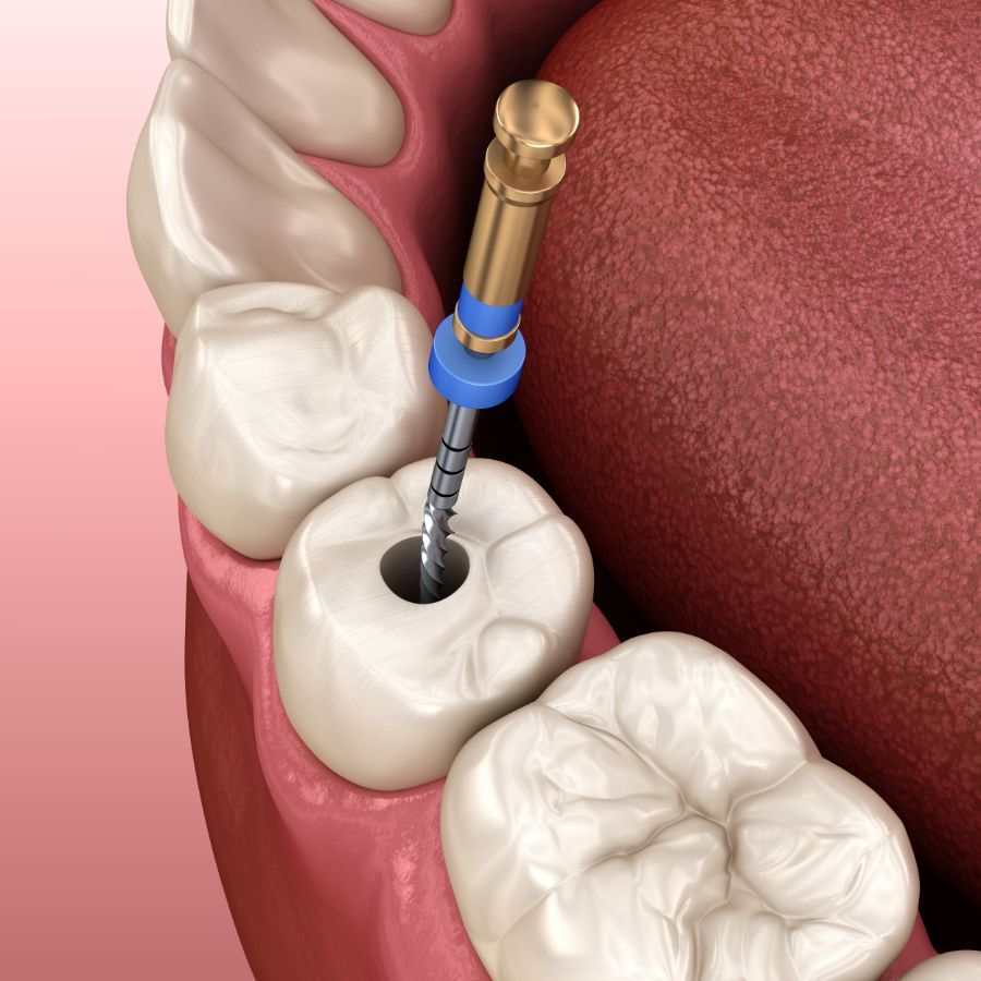 grafica endodonzia