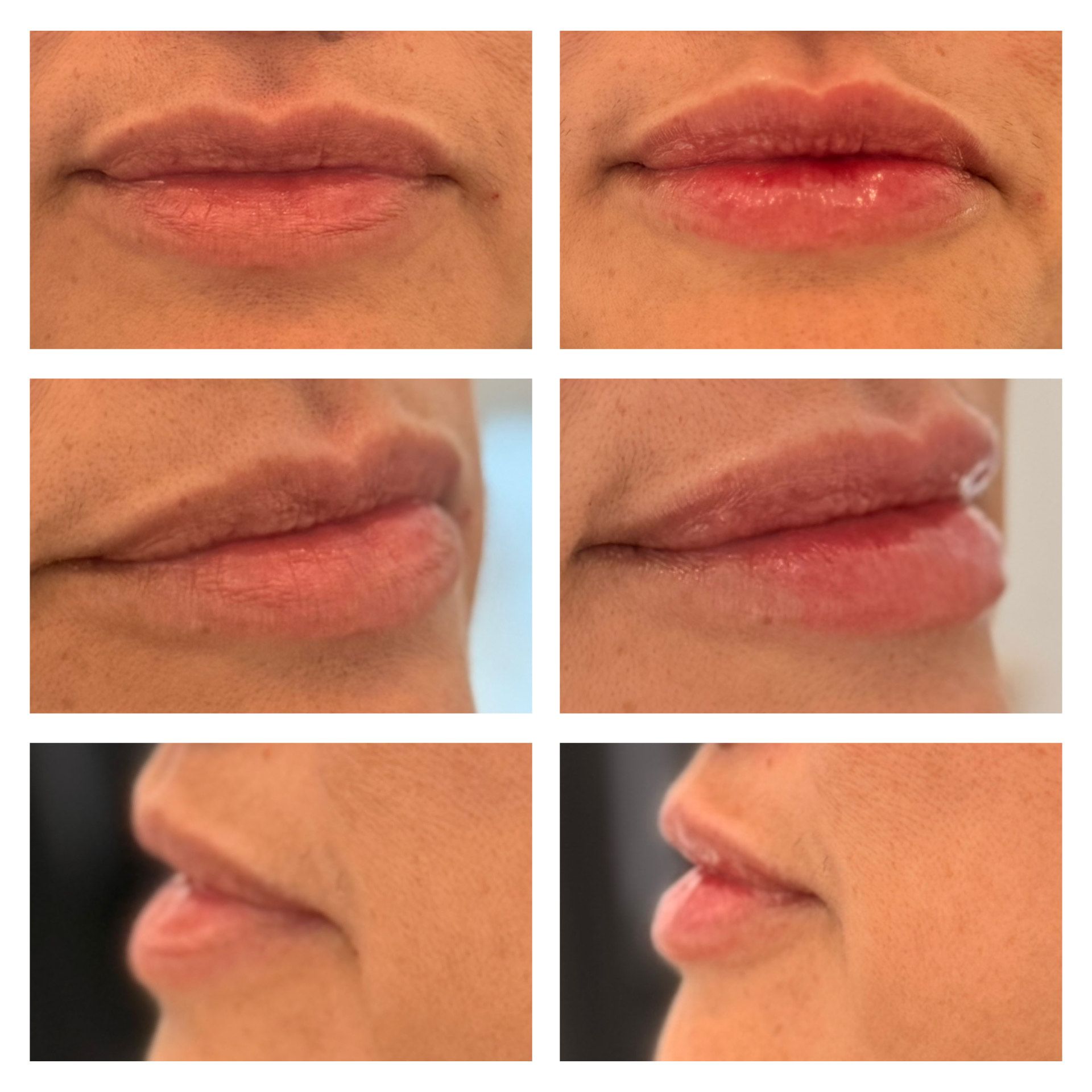 Collage of lips before and after lip filler treatment, showing increased volume and gloss.