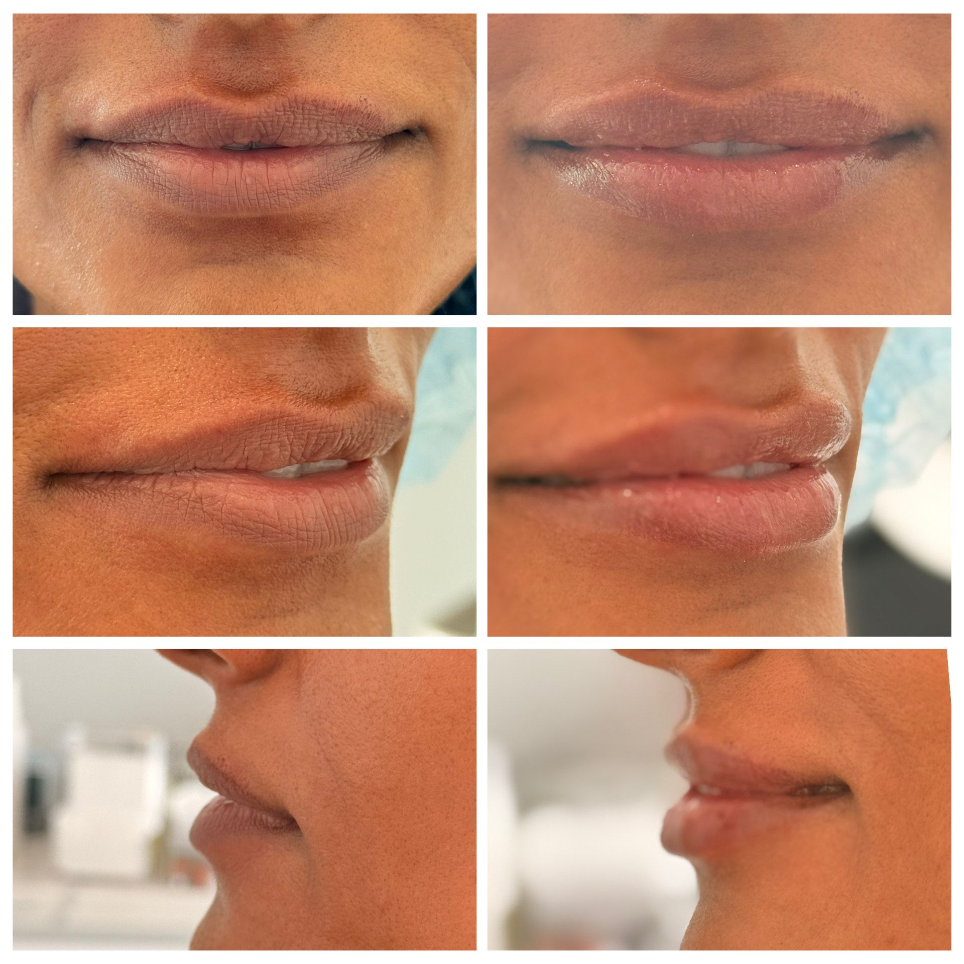 Comparison of lip before and after enhancement procedure. Front and side views show subtle changes in shape.