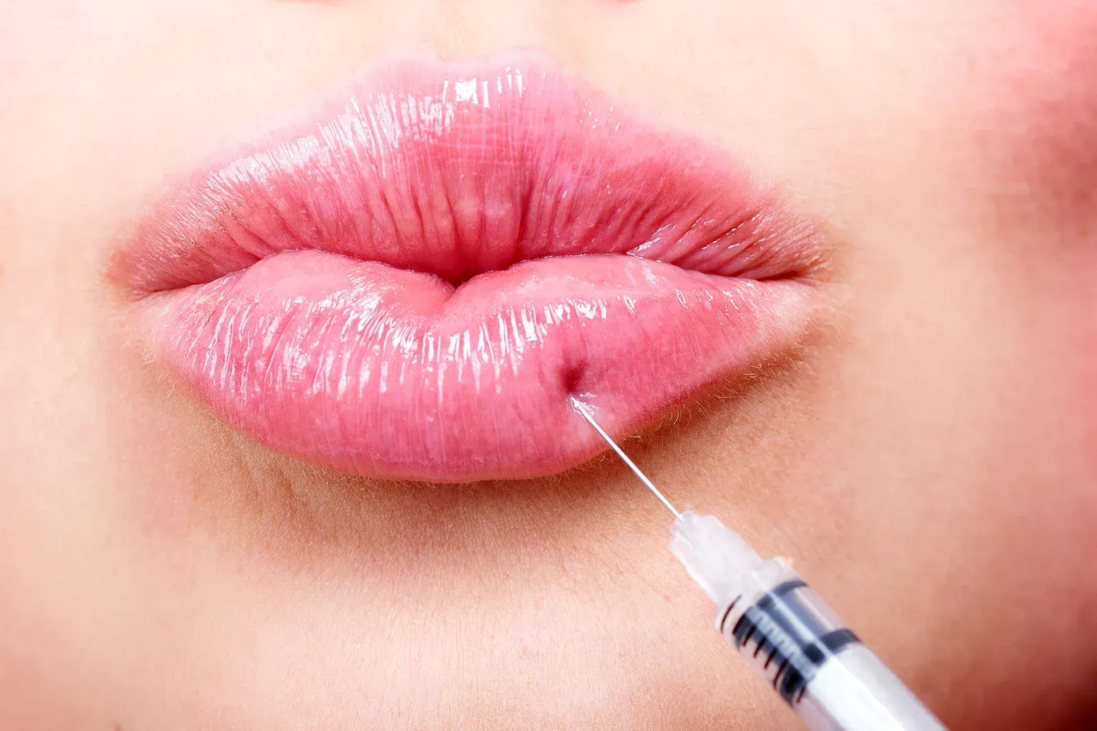 Lips being injected with a syringe for cosmetic lip augmentation.