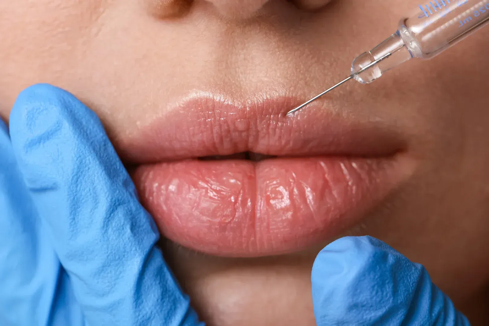 Lips being injected with a syringe. A gloved hand holds the lip.