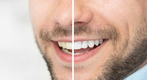 Teeth Whitening Procedure — St. Clair Shores, MI — Richard G. Raad, DDS, PC