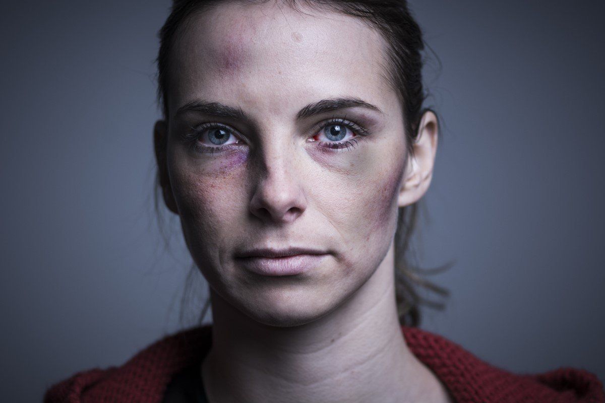Close-up portrait of a woman with a bruised face against a gray background