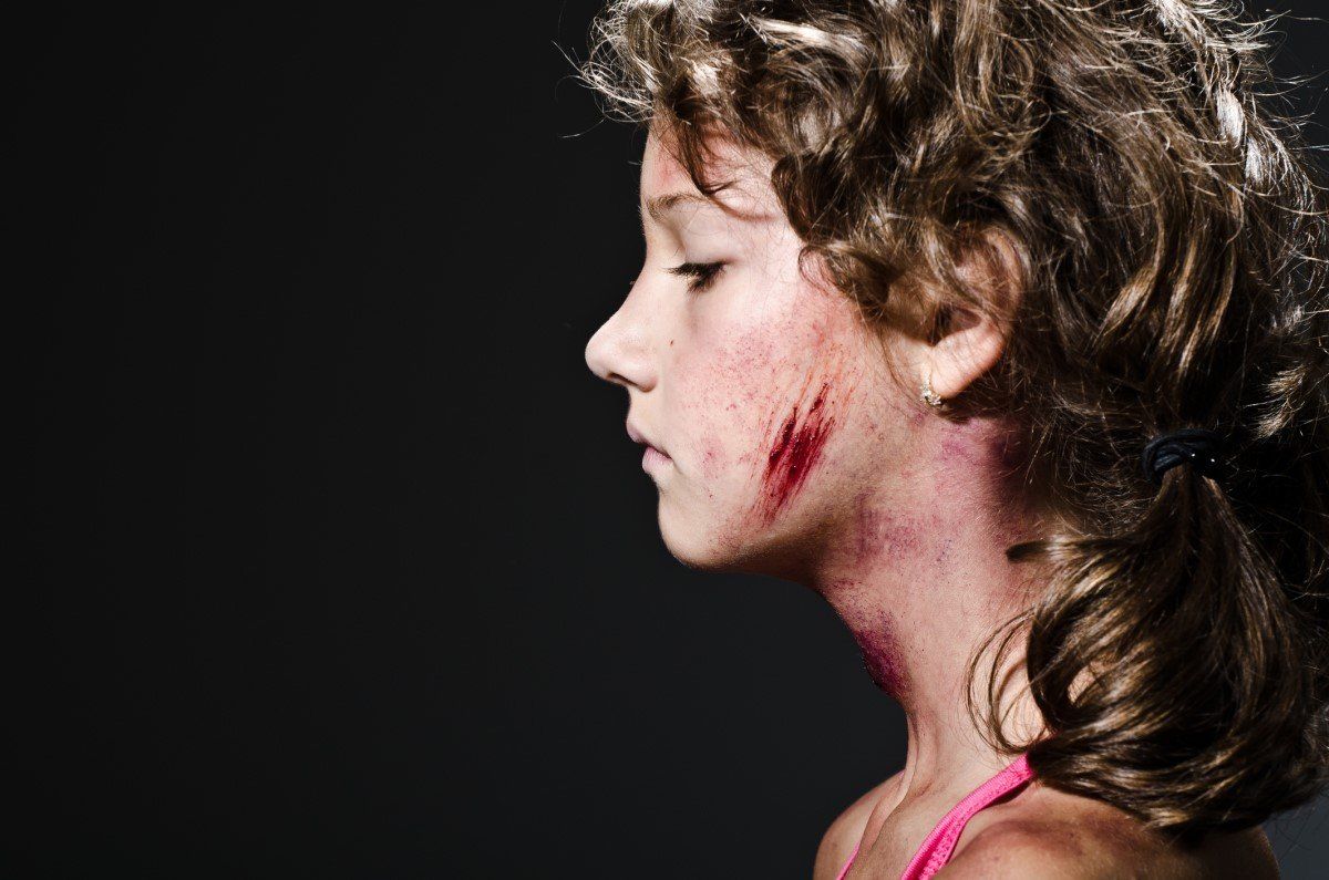 Profile of a child with a scraped cheek and neck against a dark background
