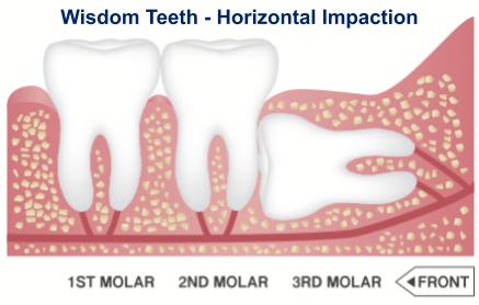 Wisdom Teeth Horizontal Impaction