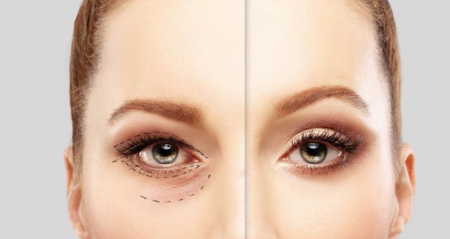 Eyelid Surgery