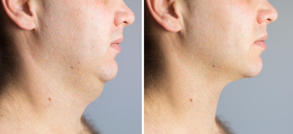 Side-by-side profile photos showing a man's chin and jawline before and after shaving.