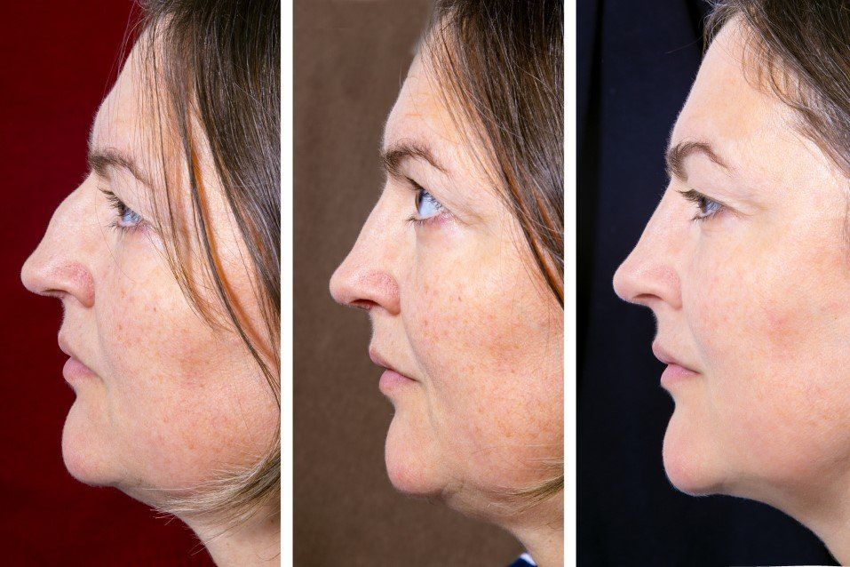 Three side-profile portraits of a person’s face, showing a nose profile comparison from left to right.
