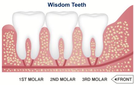 Wisdom Tooth
