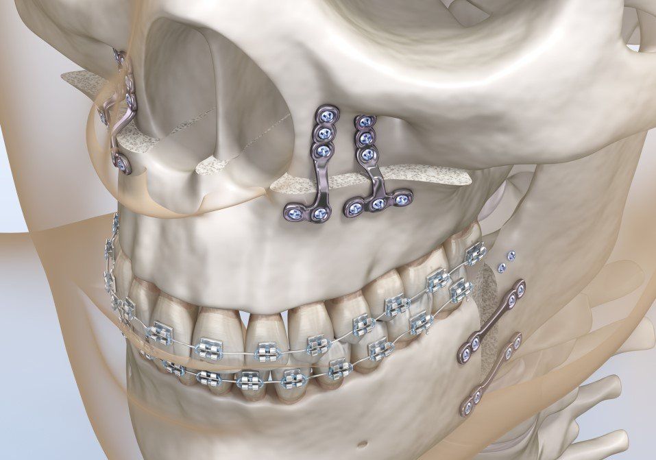 Side view of a skull with facial bone fixation plates and orthodontic braces on the teeth