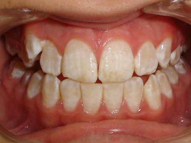 Vamos Nos Atentar A Quantidade De Fluor