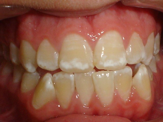 Vamos Nos Atentar A Quantidade De Fluor