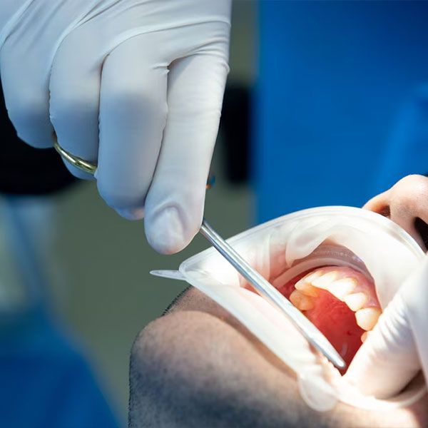 medical denture and bond grafting | Get bone grafting for your dental implants | Houston Dentist 77042