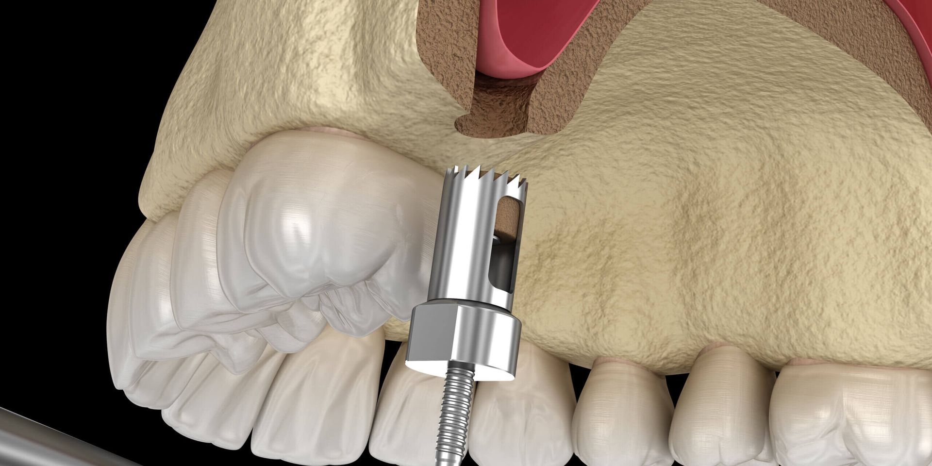Sinus Lift Procedure Image | Top Houston 77042 Dentist