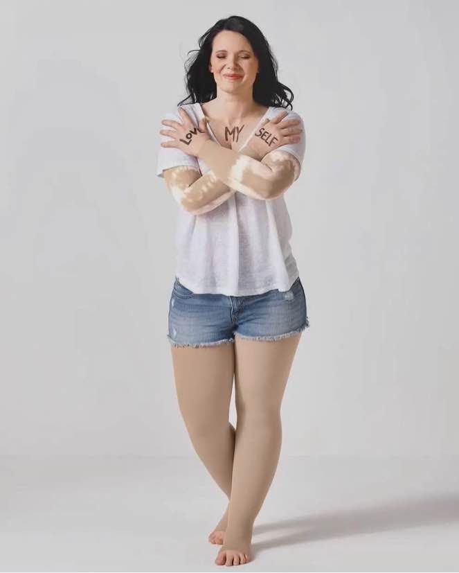 Calze compressive per linfedema e lipedema