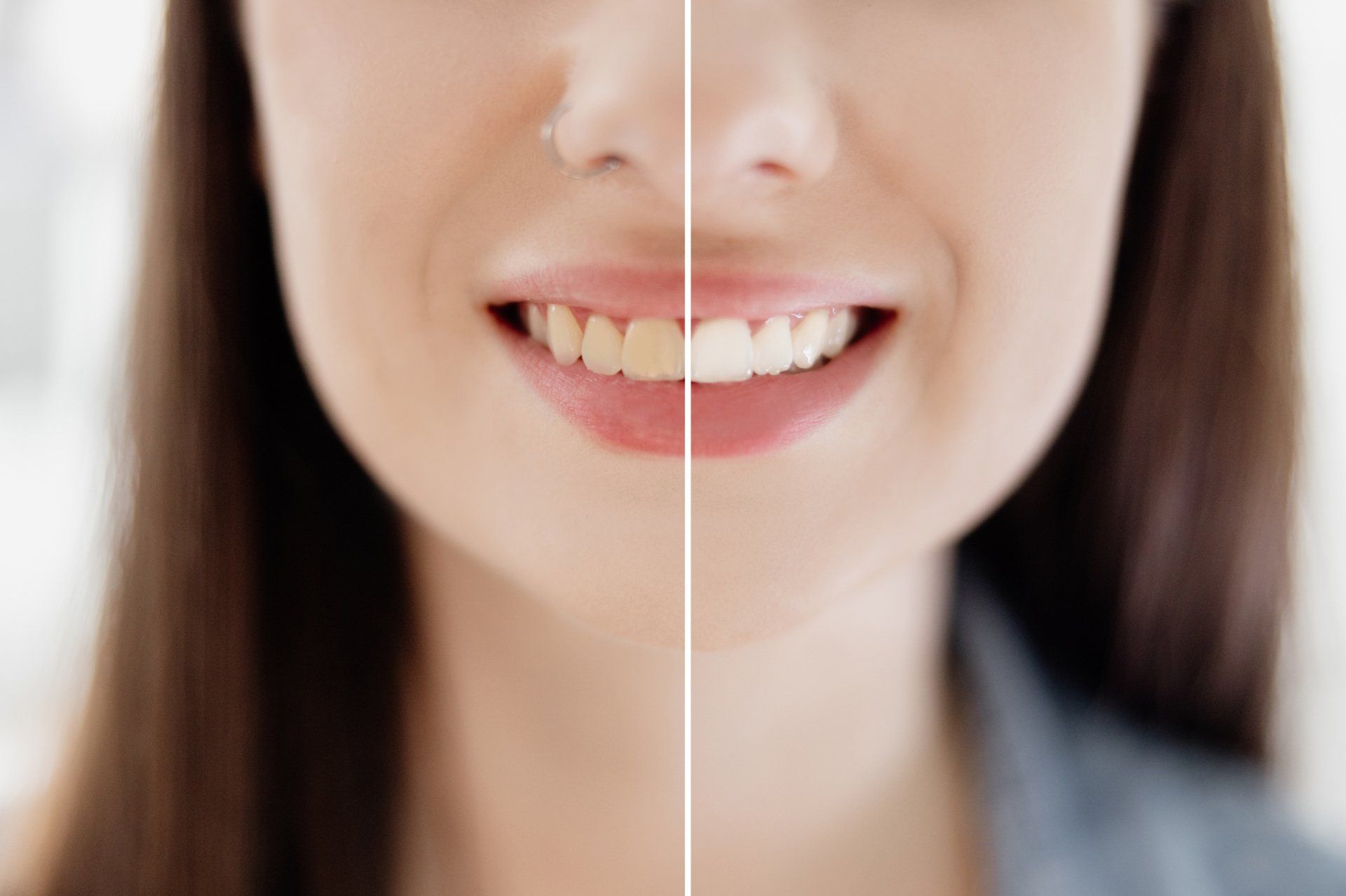 Teeth Whitening — Maryville, TN — Blount Laser Dentistry