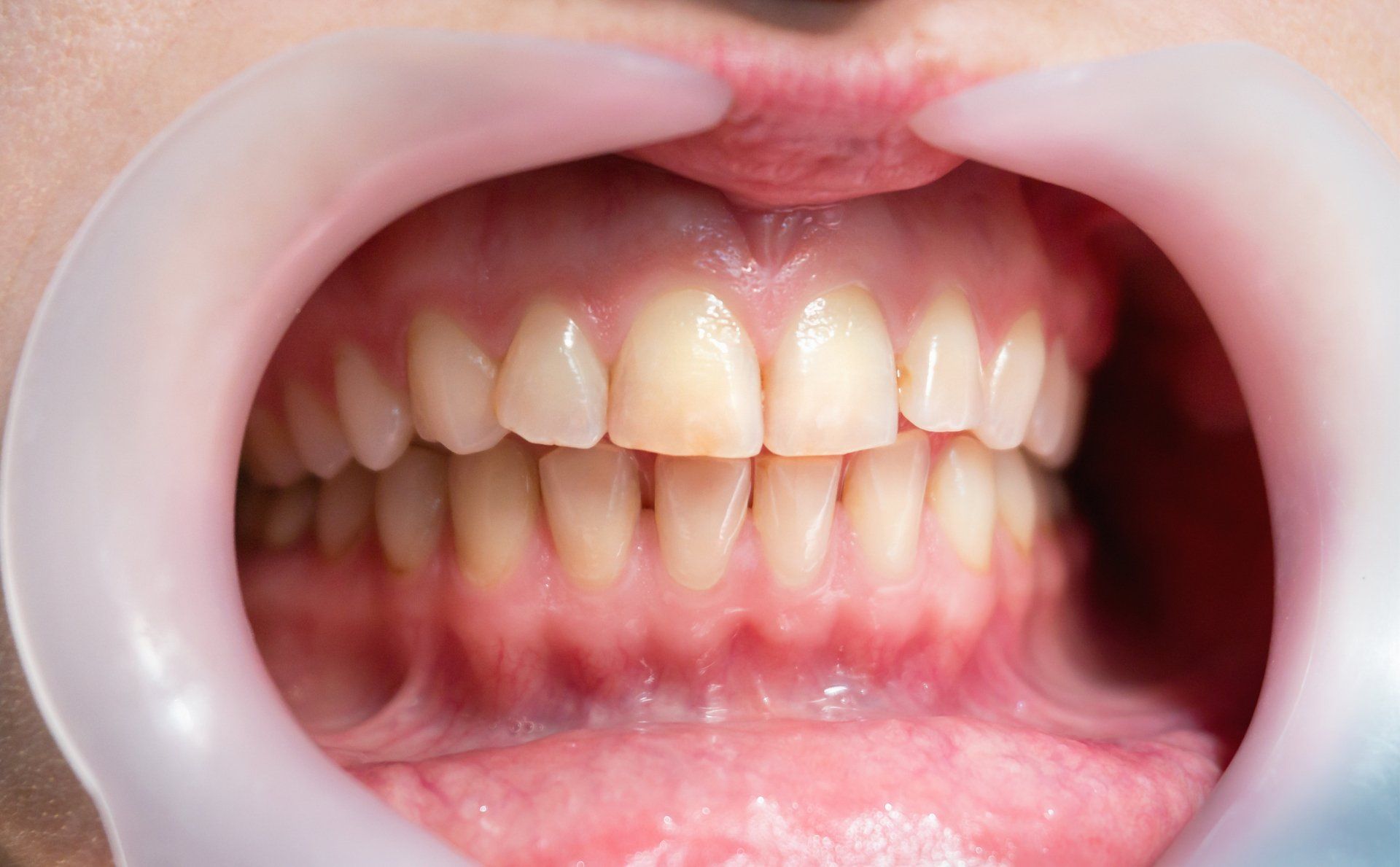 Tooth Bonding — Maryville, TN — Blount Laser Dentistry
