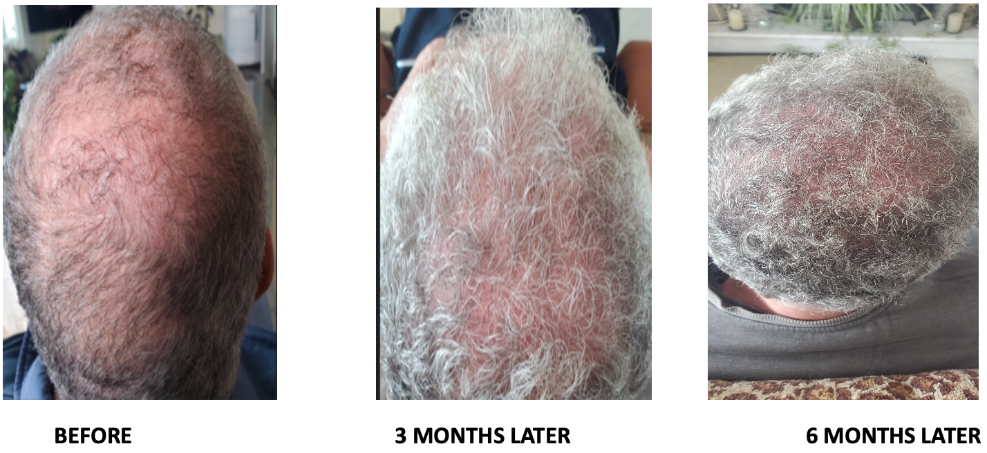 PRP Hair Restoration Therapy