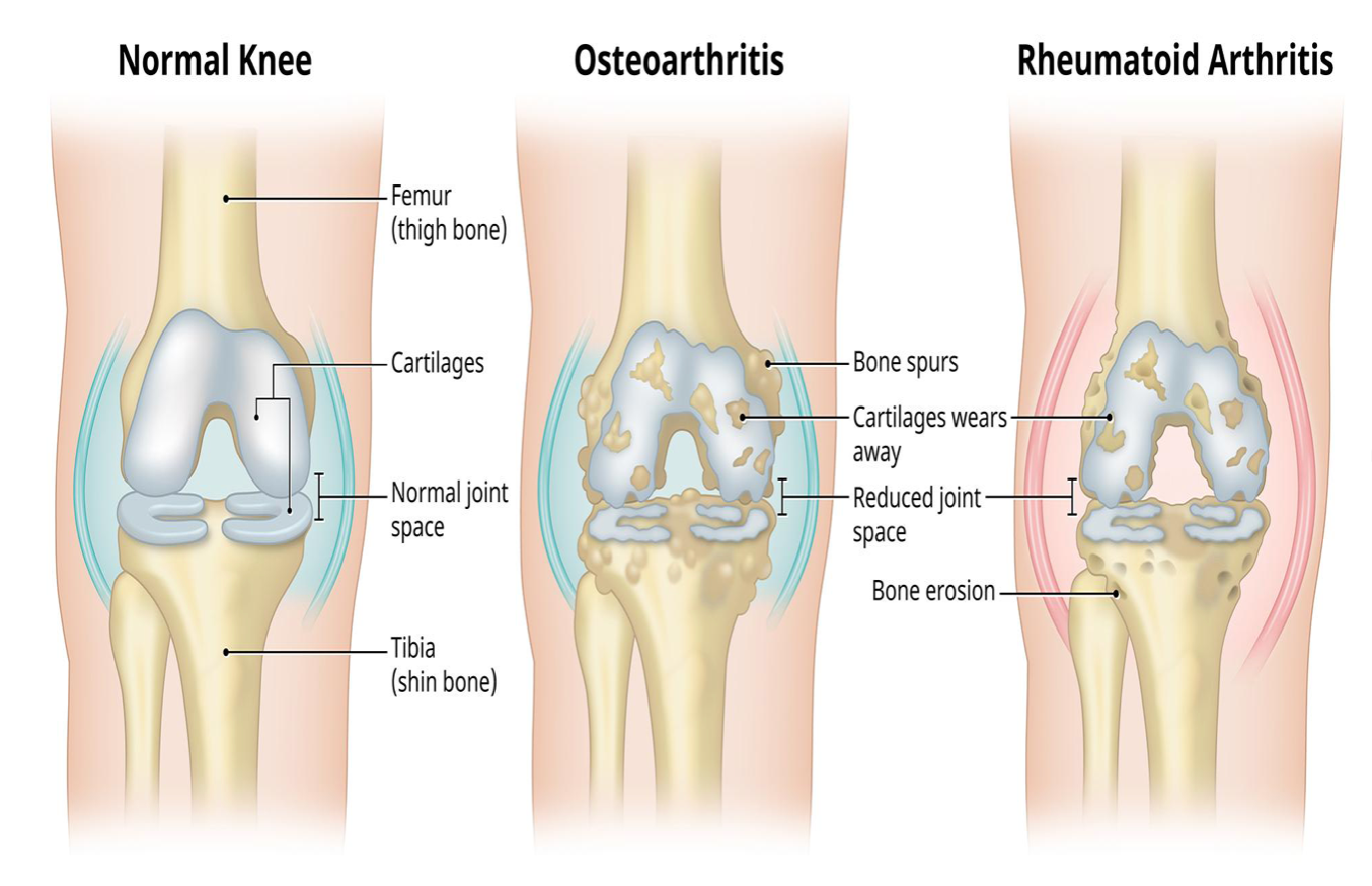 Chronic joint pain or arthritis