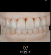 Modelo dental que muestra una fila de carillas de porcelana blanca brillante.