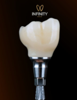 Corona dental sobre implante, color beige con base metálica, fondo oscuro.