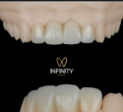 Primer plano del trabajo dental que muestra un puente, hecho de porcelana blanca brillante, sobre un modelo de diente.