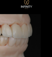 Modelo de dientes, resaltando un tratamiento dental, con un logotipo.