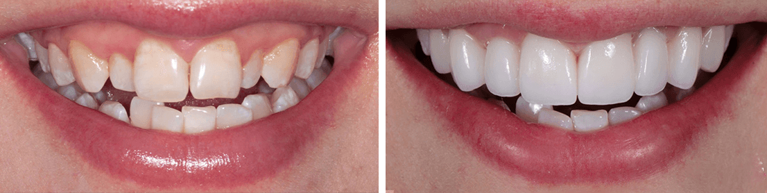 Before and after comparison of a smile, showing the teeth before, then after cosmetic dental work.