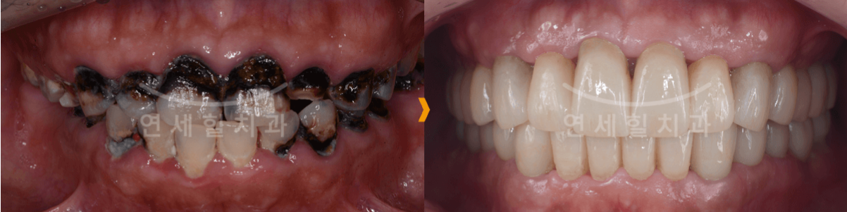 Side-by-side comparison of unhealthy and healthy teeth. The before shows decayed teeth. The after shows a bright, white smile.