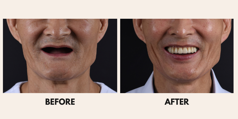 Man before and after dental work, showing missing teeth before, and smile after.