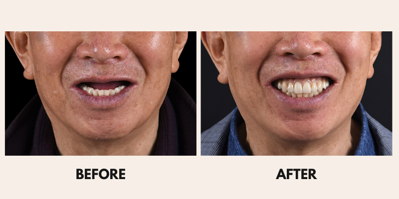 A man's face before and after a procedure, showing a change in expression from neutral to smiling with open mouth.