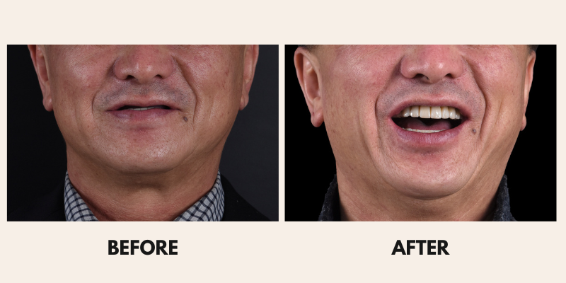 Man before and after dental work, showing missing teeth before, and smile after.