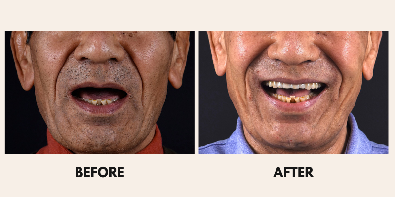 Before and after dental procedure: Smiling Asian man with new teeth.