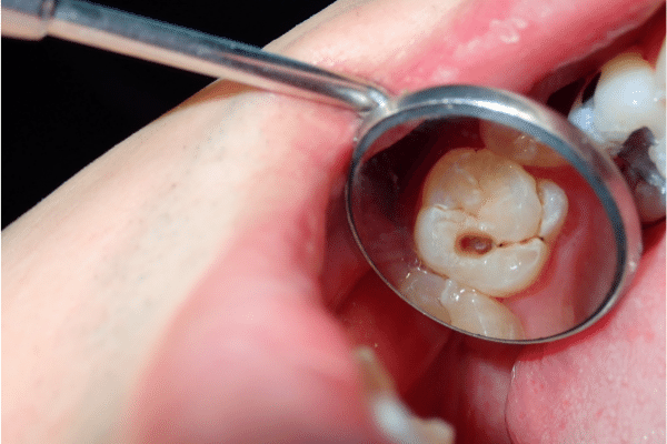 A person is getting their teeth examined by a dentist with a mirror.