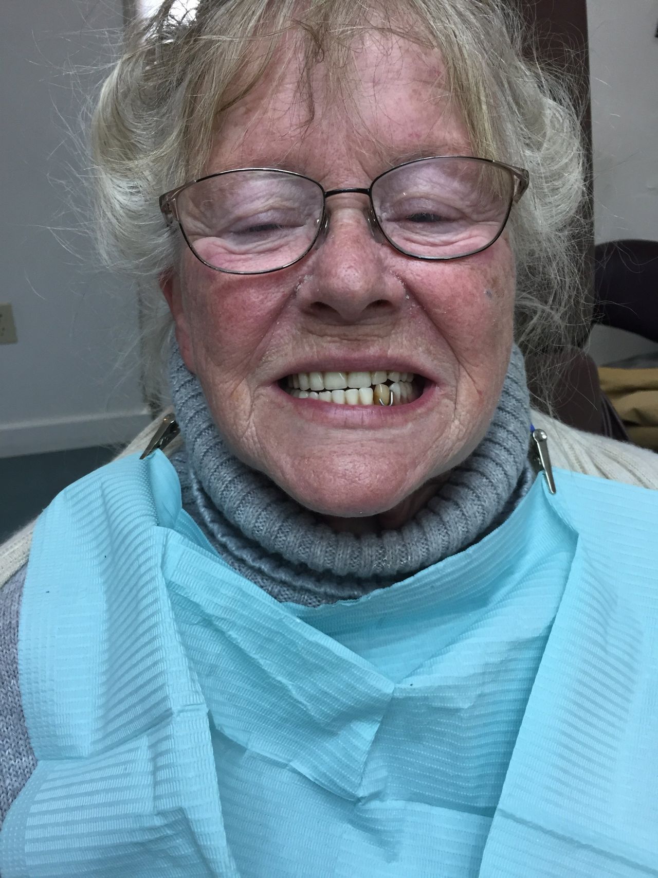 Patient Before 2 — Kennebunk, ME — Denture Solutions