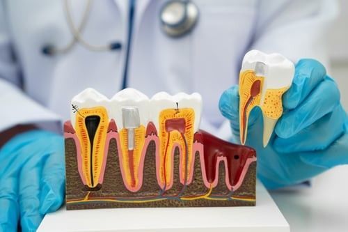 Early Signs of Tooth Decay You Shouldn’t Ignore | Patriot Family Dental