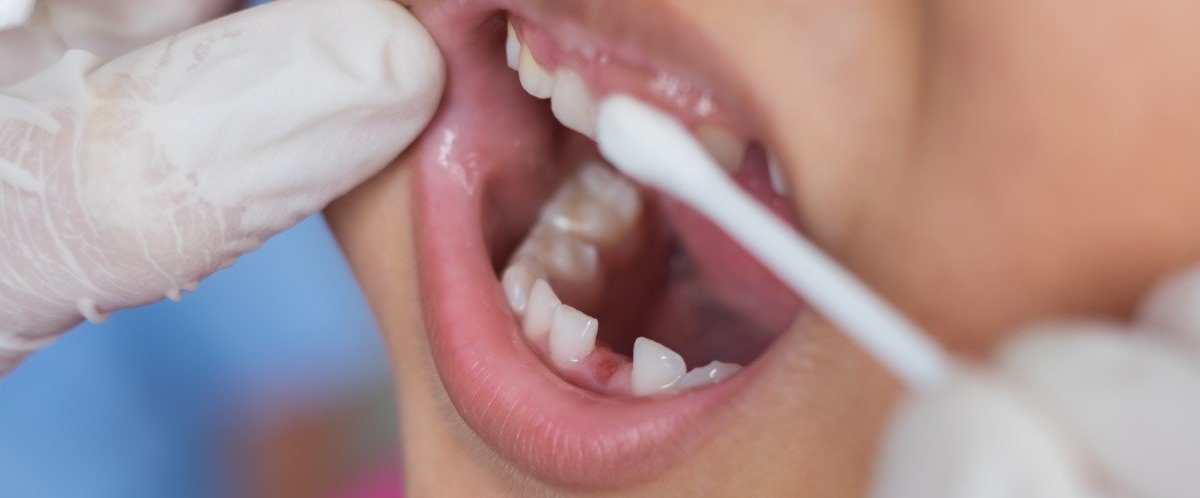 dental fluoride treatments