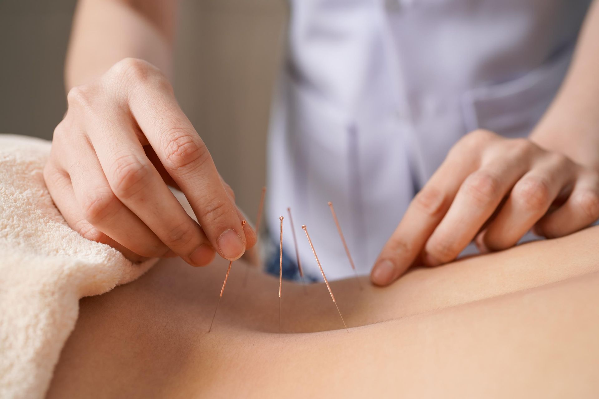 Hands placing acupuncture needles into a person's back.