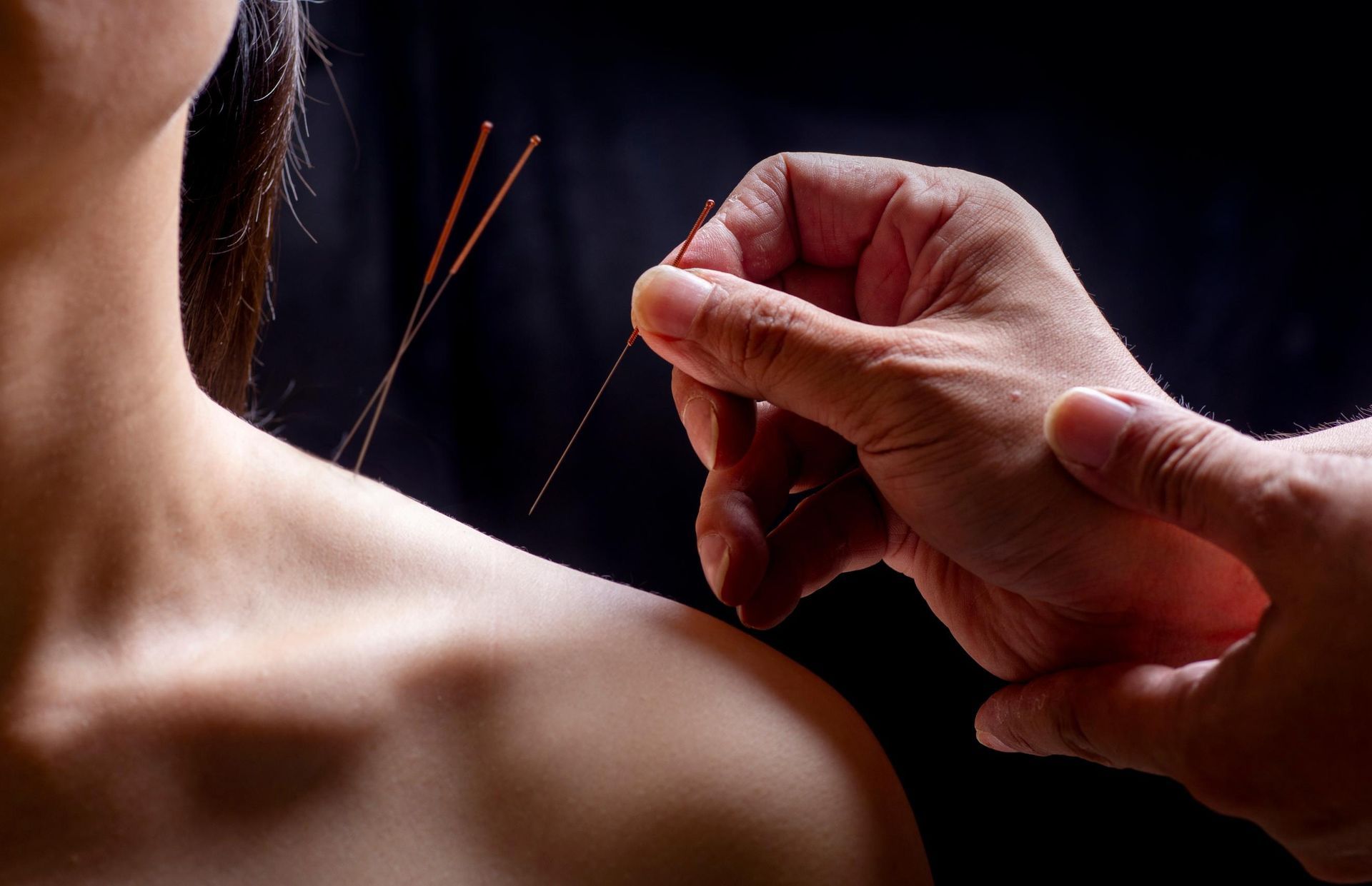 Acupuncturist inserting needles into a person's shoulder against a black background.