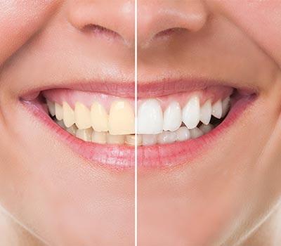 efore and after whitening — Dental work in Clinton, MS