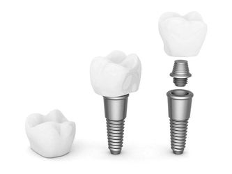 Dental Implant — Dental work in Clinton, MS 